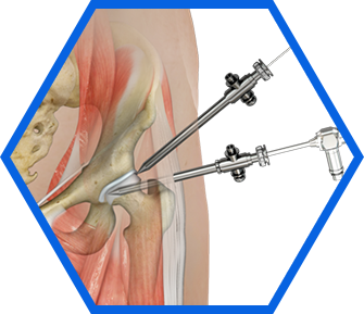 Hip Arthroscopy